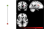 Disownership of body parts as revealed by a visual scale evaluation. An observational study